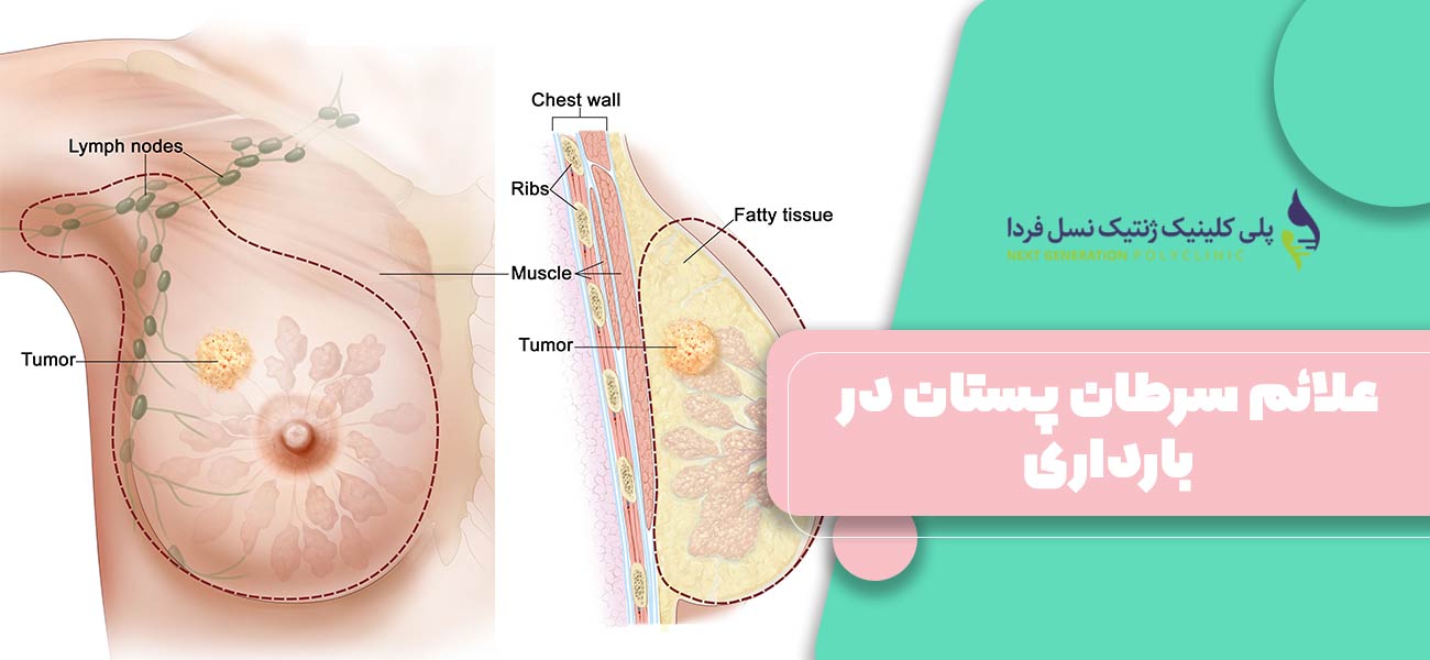 علائم سرطان پستان در بارداری