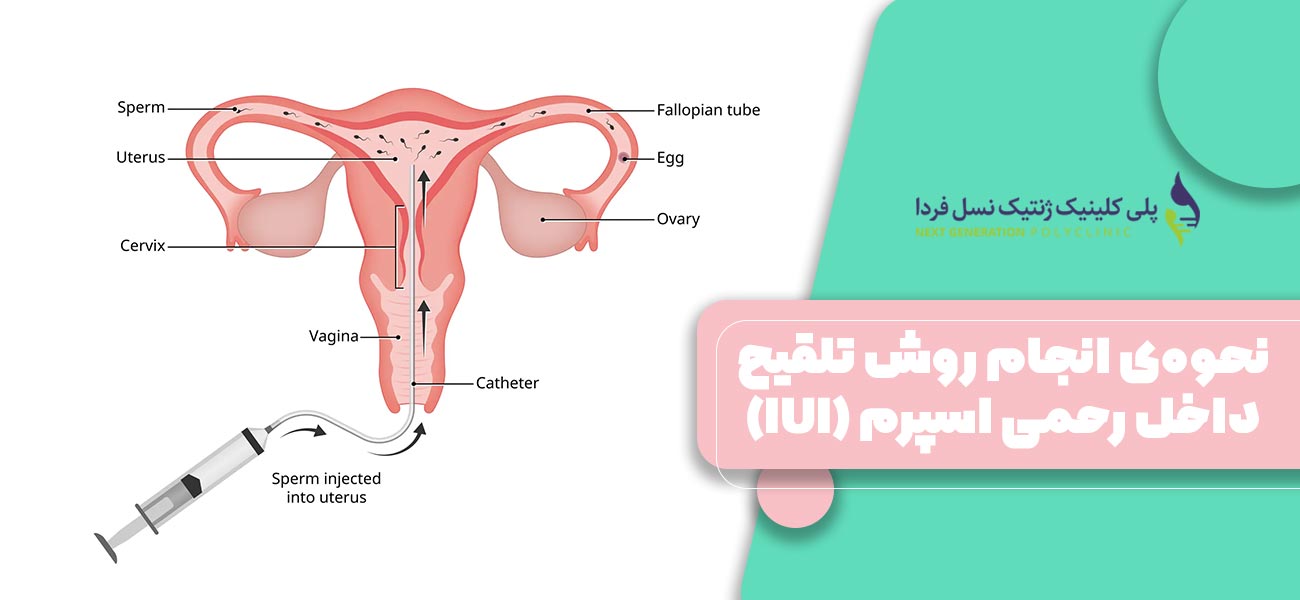 نحوهی انجام روش تلقیح داخل رحمی اسپرم (IUI)