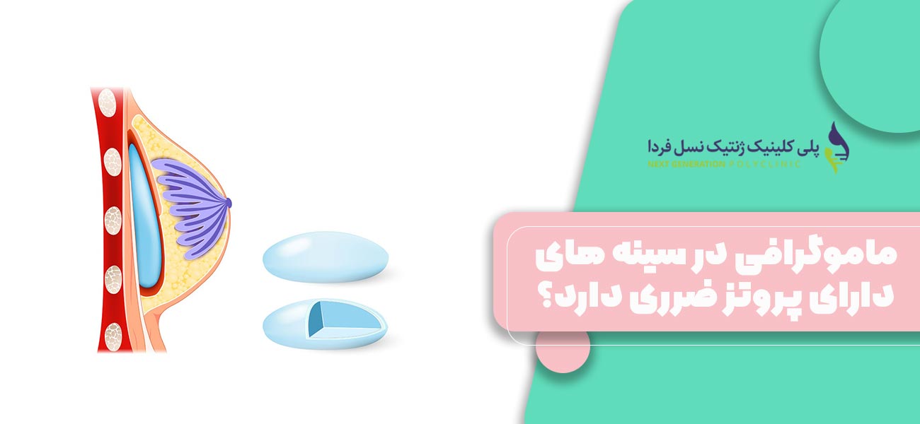 ماموگرافی در سینه های دارای پروتز ضرری دارد؟