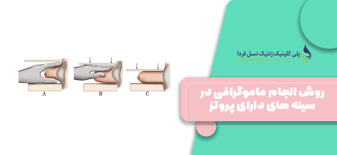 روش انجام ماموگرافی در سینه های دارای پروتز