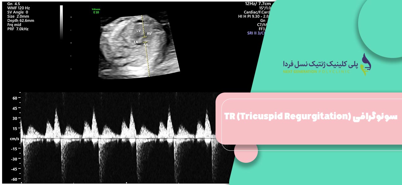 سونوگرافی TR (Tricuspid Regurgitation)