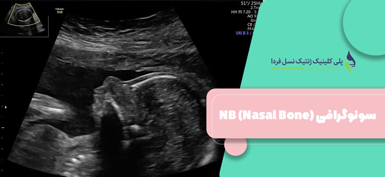 سونوگرافی NB (Nasal Bone)