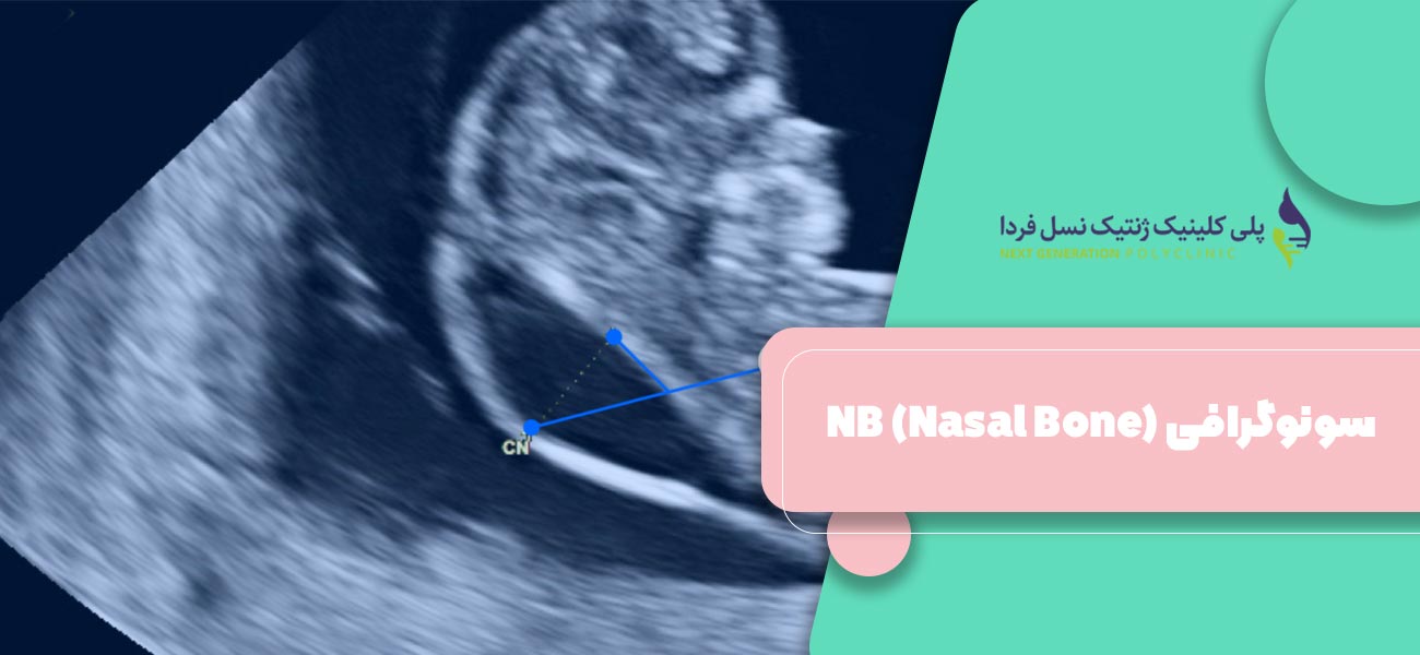 سونوگرافی NB (Nasal Bone)