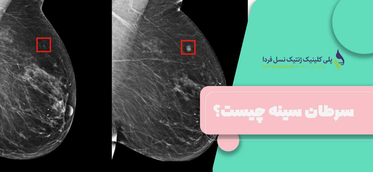 سرطان سینه چیست؟