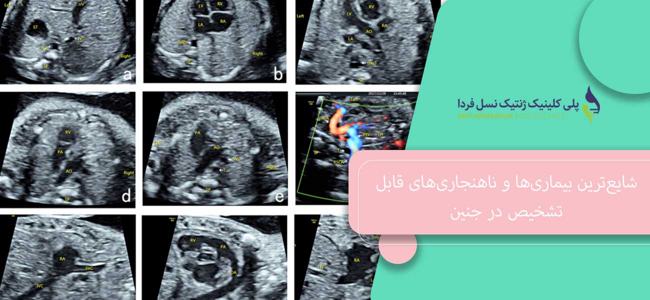 شایعترین بیماریها و ناهنجاریهای قابل تشخیص در جنین