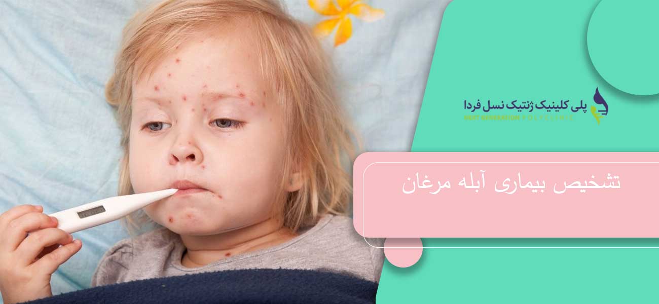 تشخیص بیماری آبله مرغان