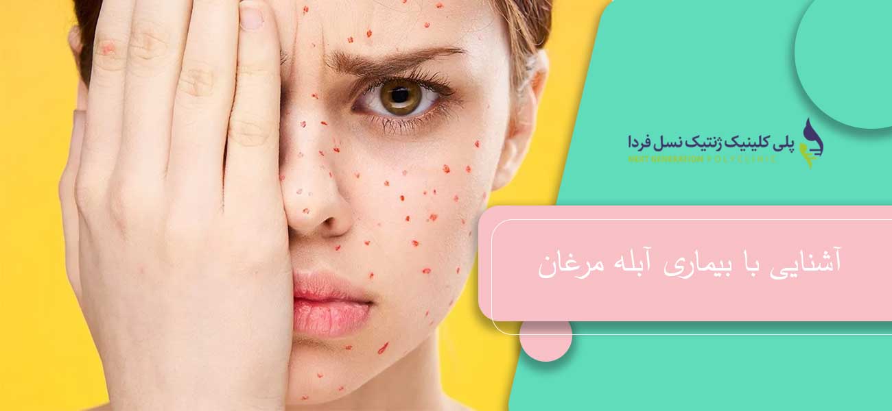 آشنایی با بیماری آبله مرغان
