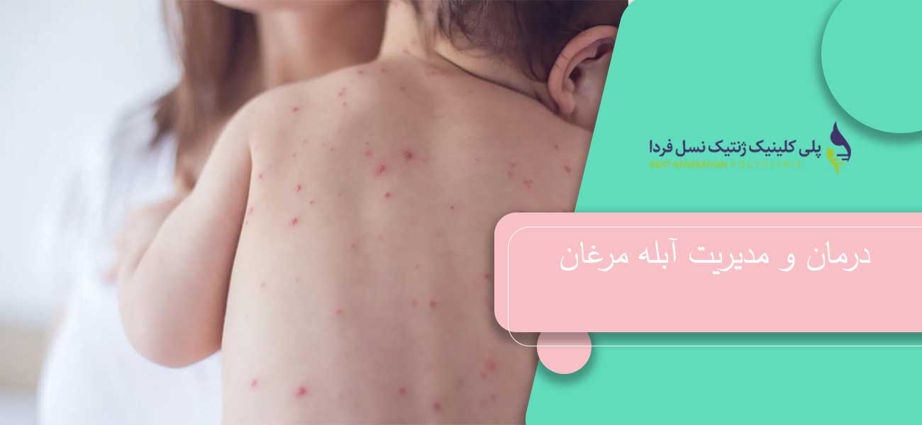 درمان و مدیریت آبله مرغان