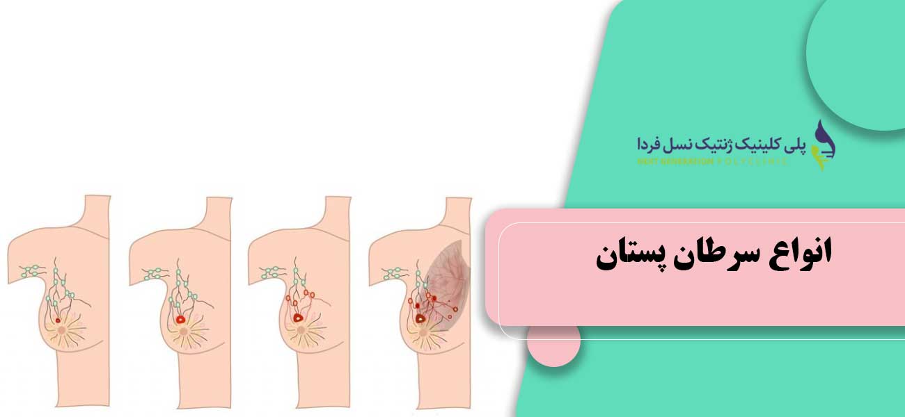 انواع سرطان پستان
