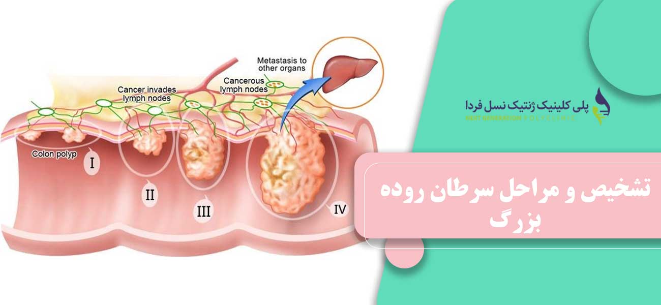 تشخیص و مراحل سرطان روده بزرگ