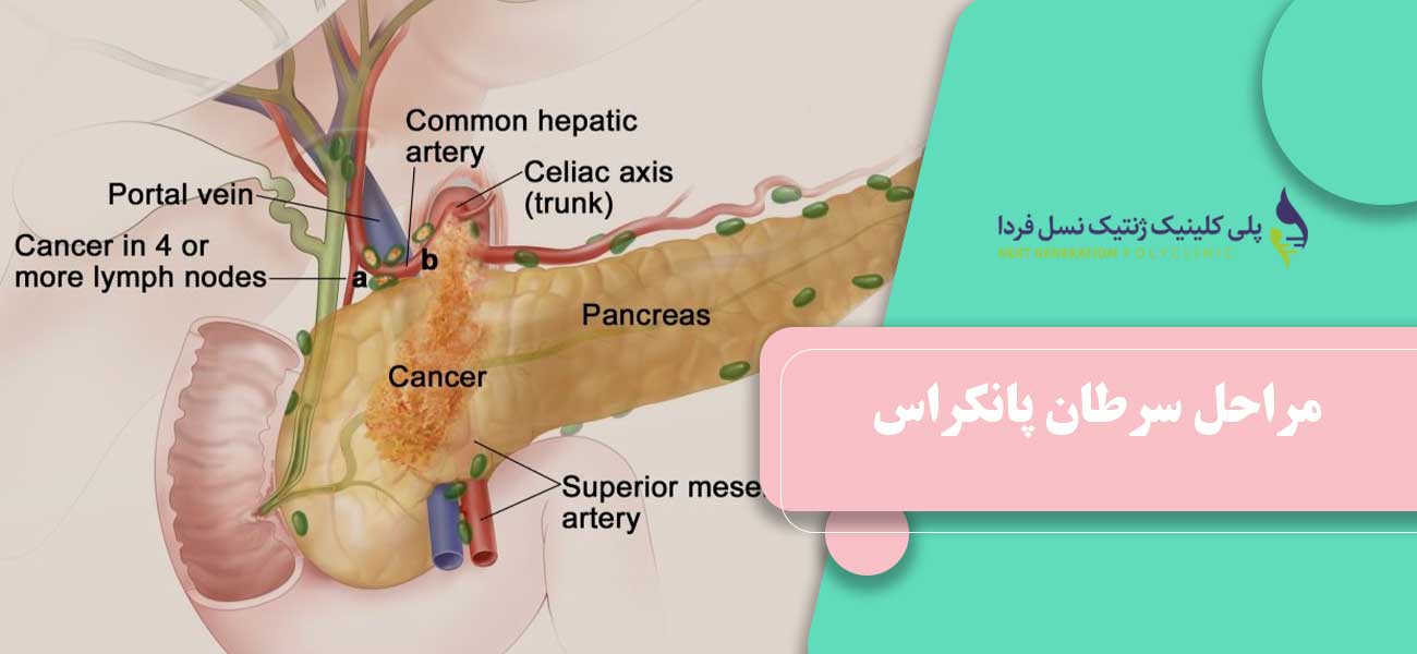 مراحل سرطان پانکراس