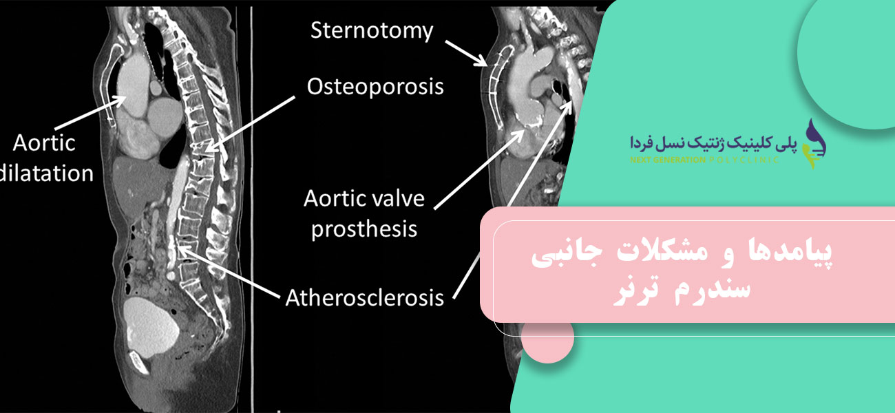 پیامدها و مشکلات جانبی سندرم ترنر