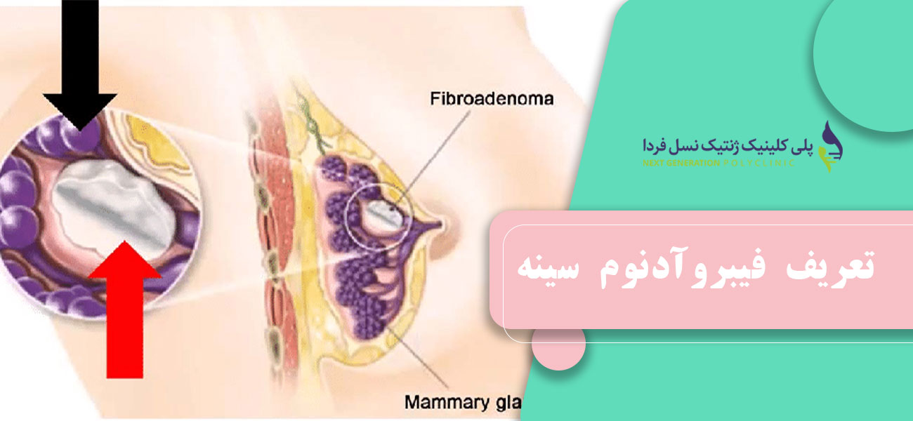 تعریف فیبروآدنوم سینه