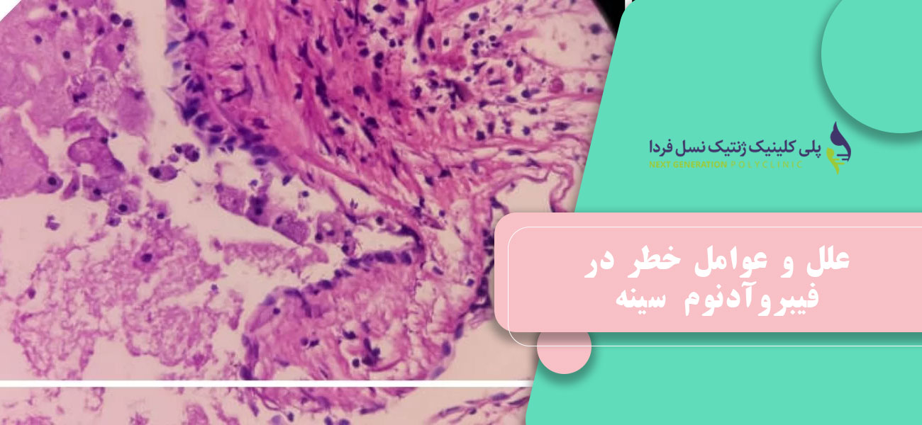 علل و عوامل خطر در فیبروآدنوم سینه