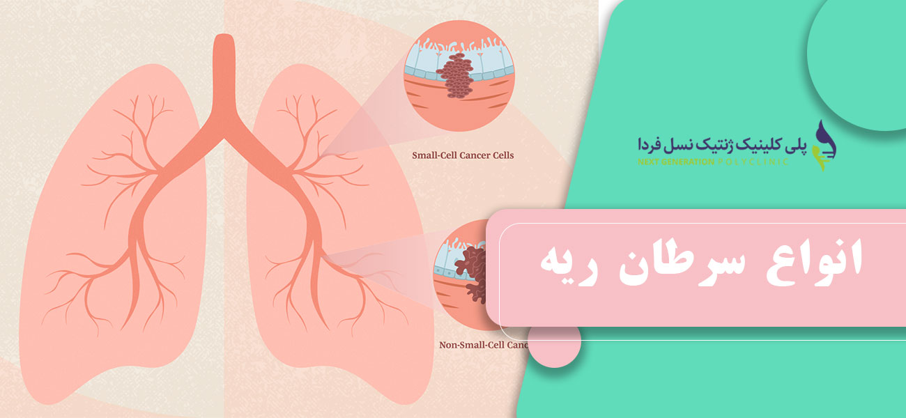 انواع سرطان ریه