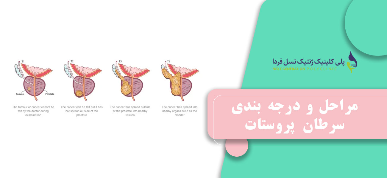 مراحل و درجه بندی سرطان پروستات