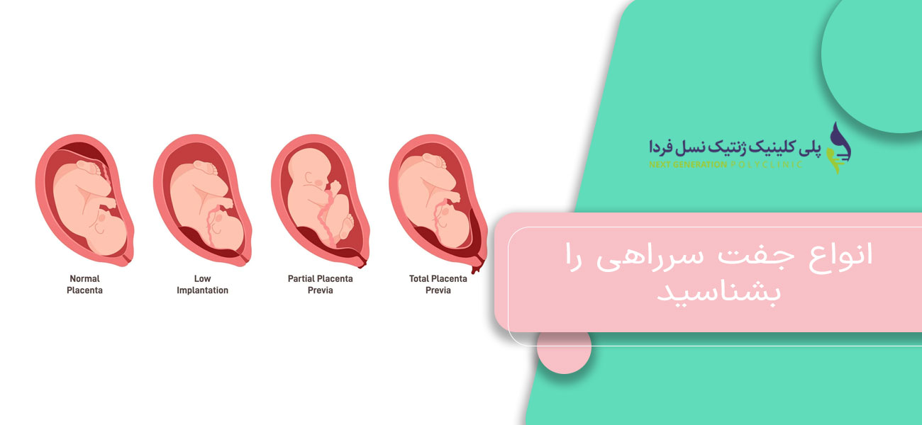 انواع جفت سرراهی را بشناسید