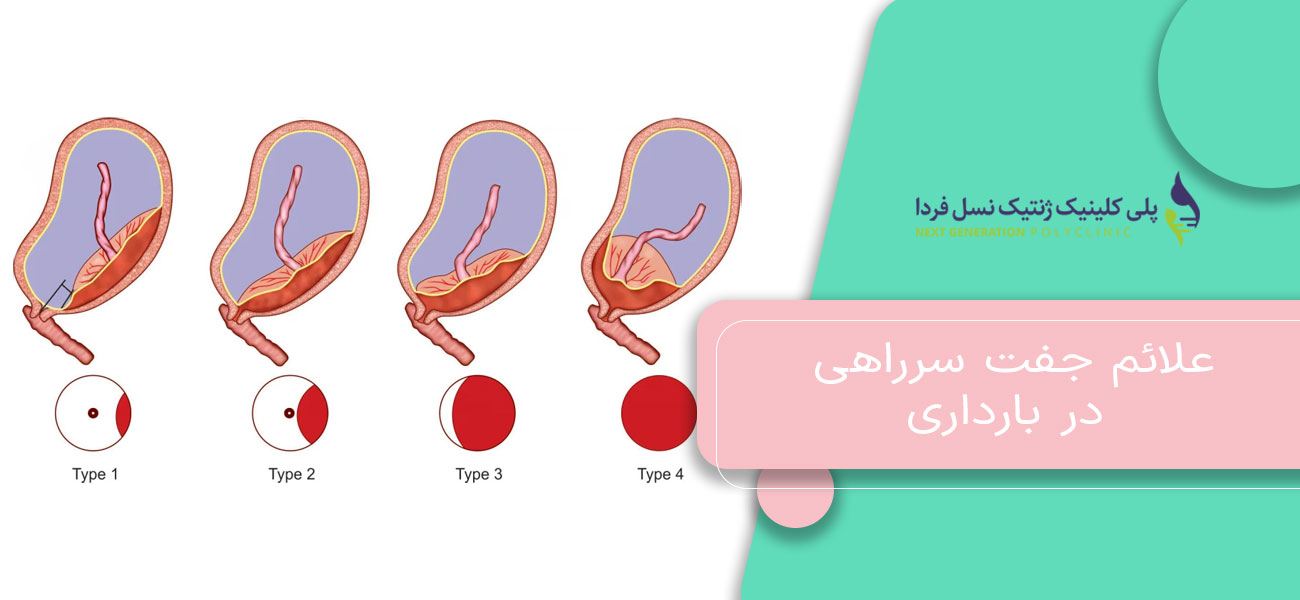 علائم جفت سرراهی در بارداری