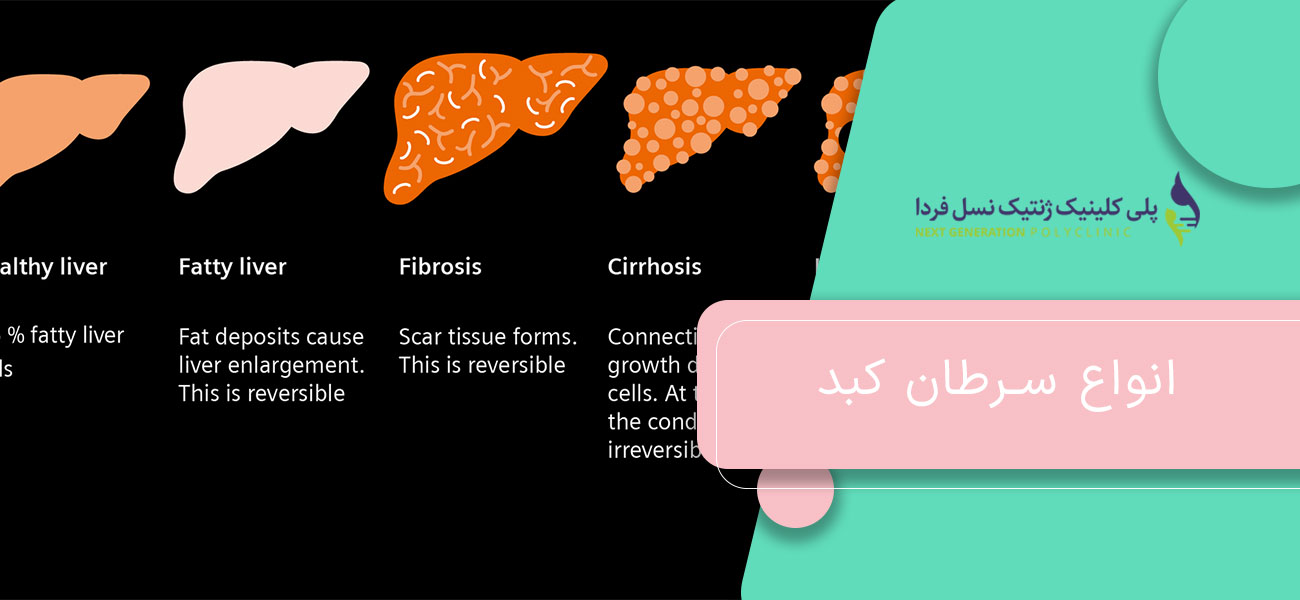 انواع سرطان کبد