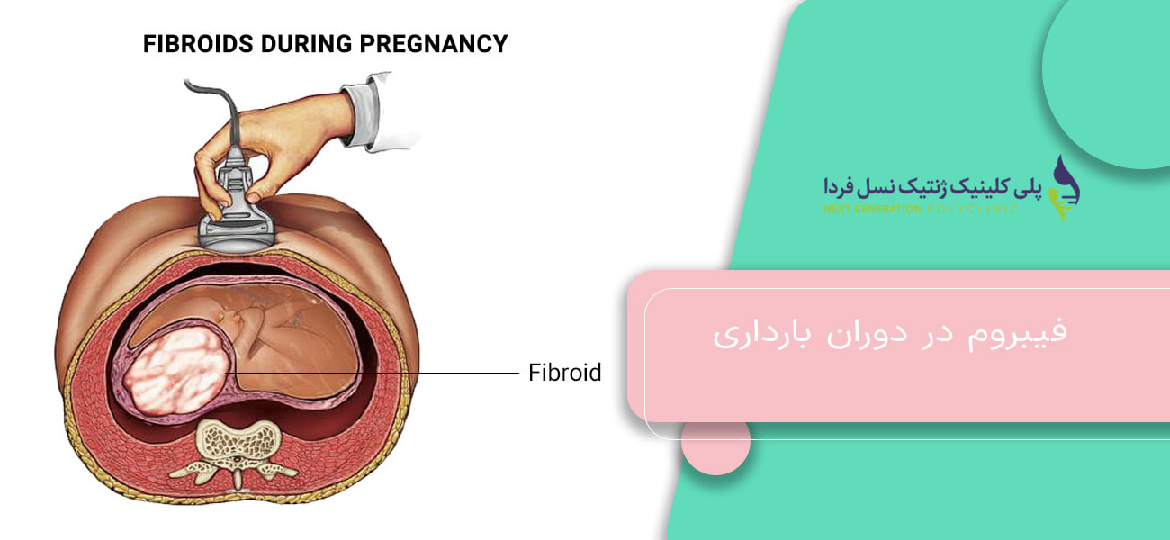 فیبروم در دوران بارداری