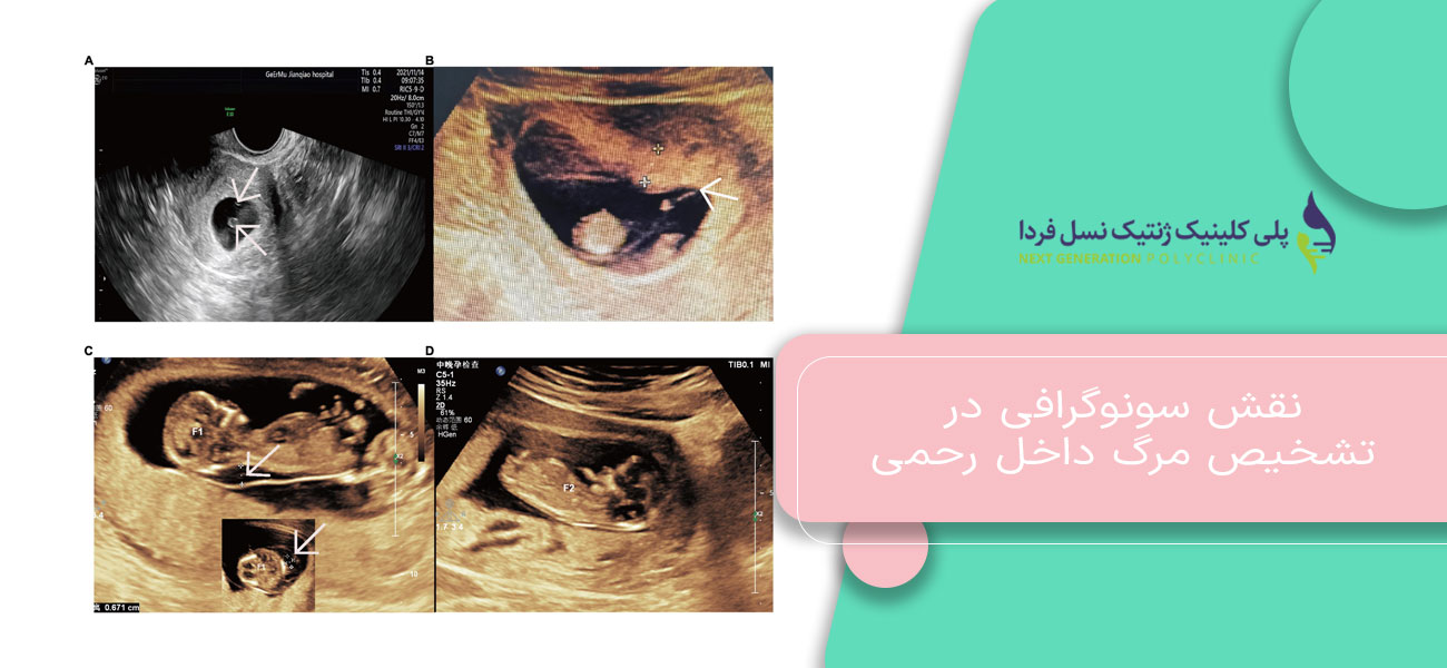 نقش سونوگرافی در تشخیص مرگ داخل رحمی