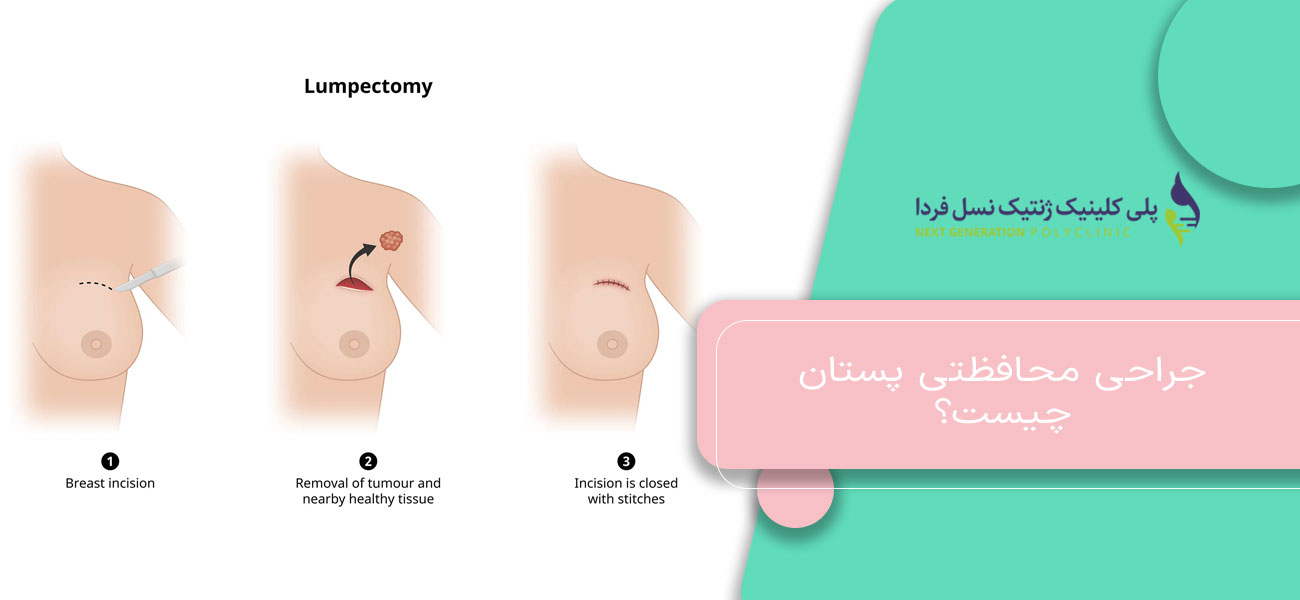 جراحی محافظتی پستان چیست؟