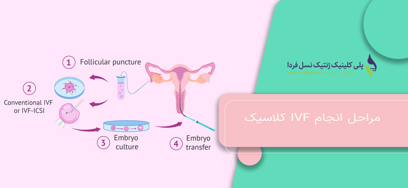 مراحل انجام IVF کلاسیک