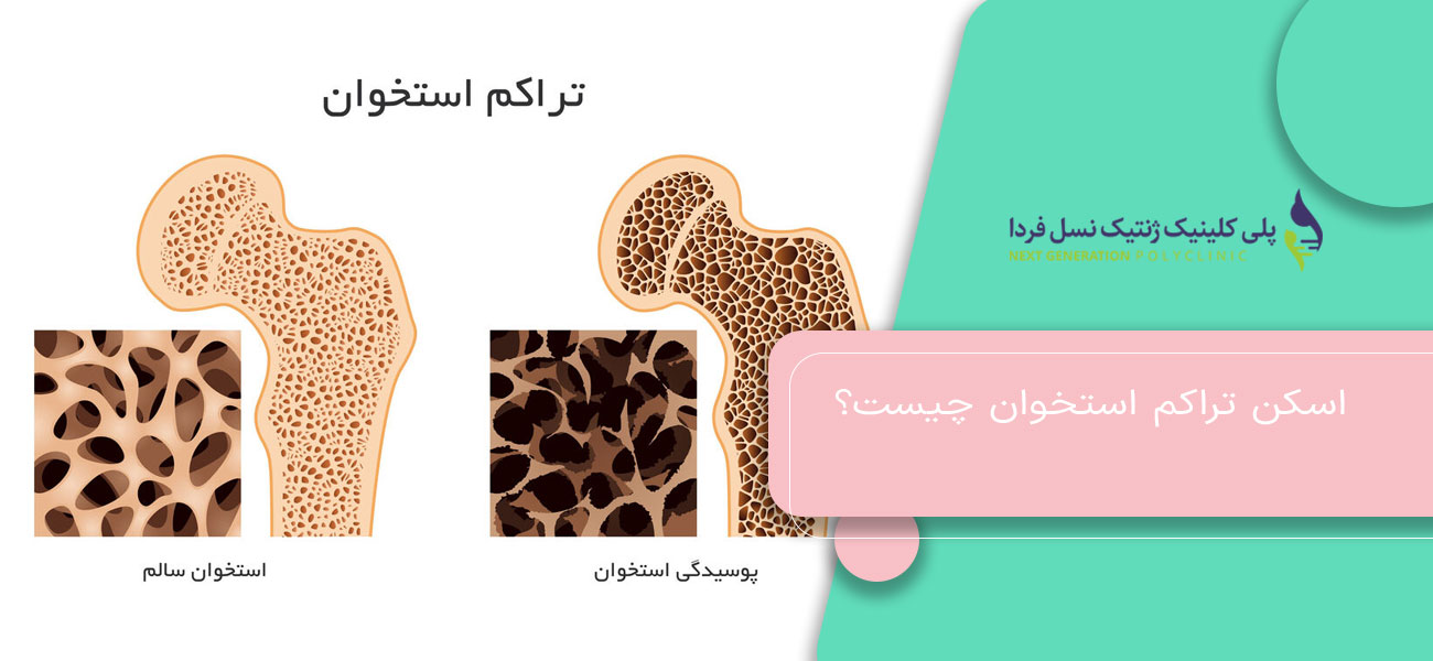 اسکن تراکم استخوان چیست