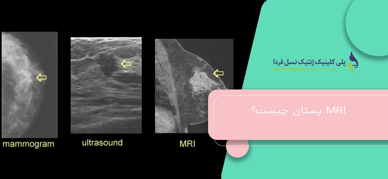 MRI پستان چیست؟