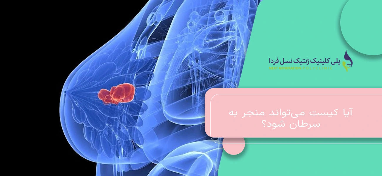 آیا کیست میتواند منجر به سرطان شود؟