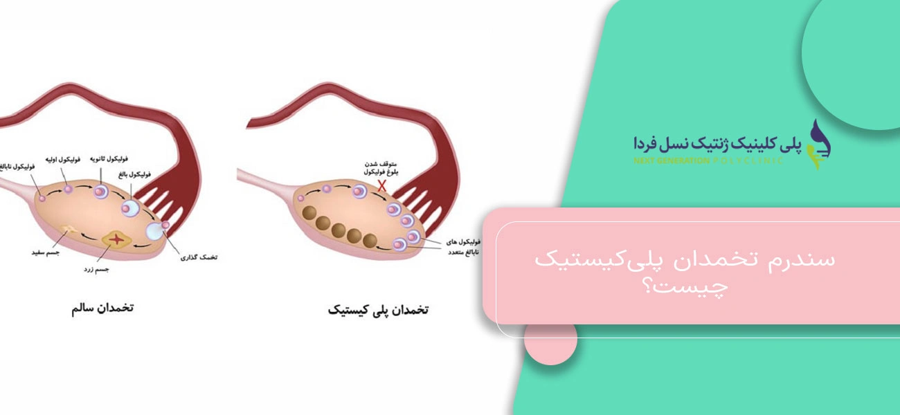 سندرم تخمدان پلیکیستیک چیست؟