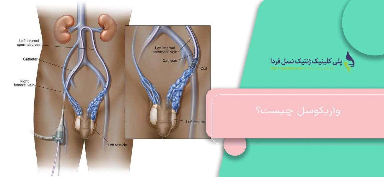 واریکوسل چیست و چگونه ایجاد میشود؟