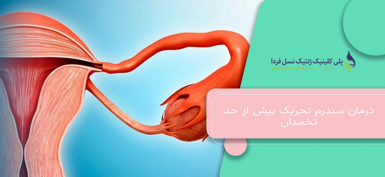 درمان سندرم تحریک بیش از حد تخمدان