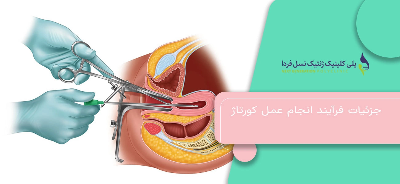 جزئیات فرآیند انجام عمل کورتاژ