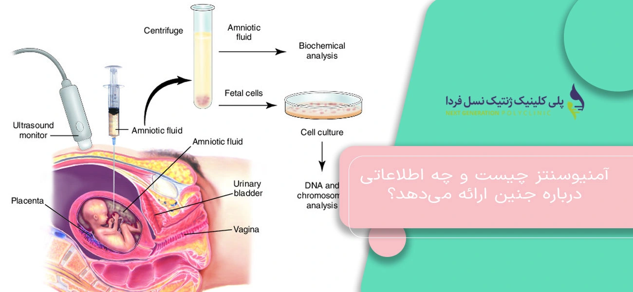 آمنیوسنتز چیست و چه اطلاعاتی درباره جنین ارائه میدهد؟