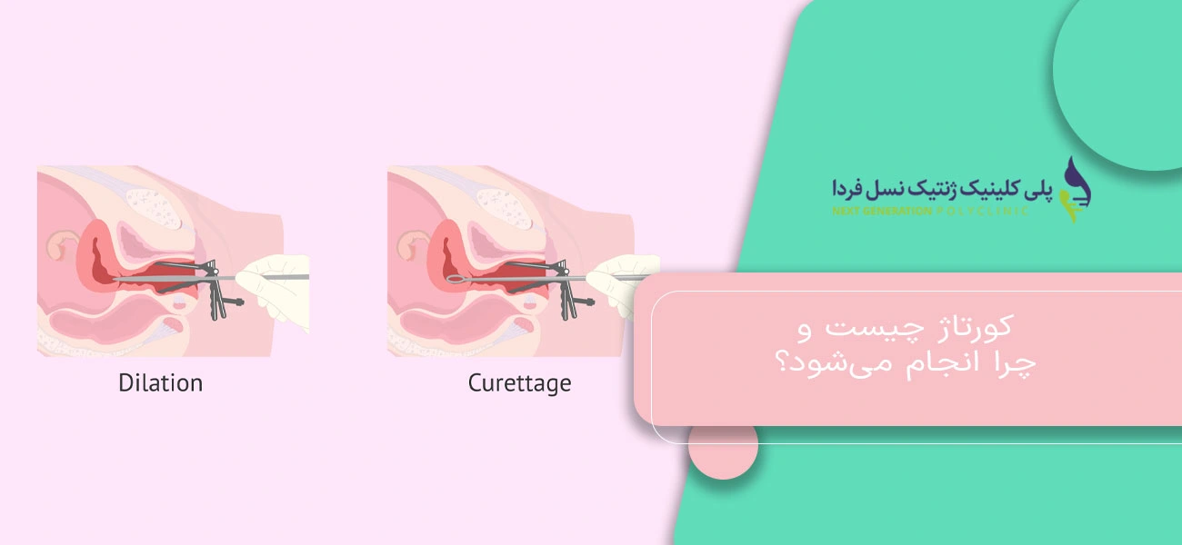 کورتاژ چیست و چرا انجام میشود؟