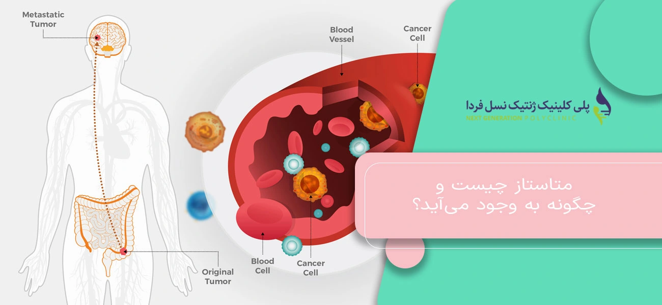 متاستاز چیست و چگونه به وجود میآید؟